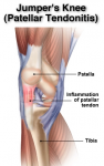 patellar tendonitis